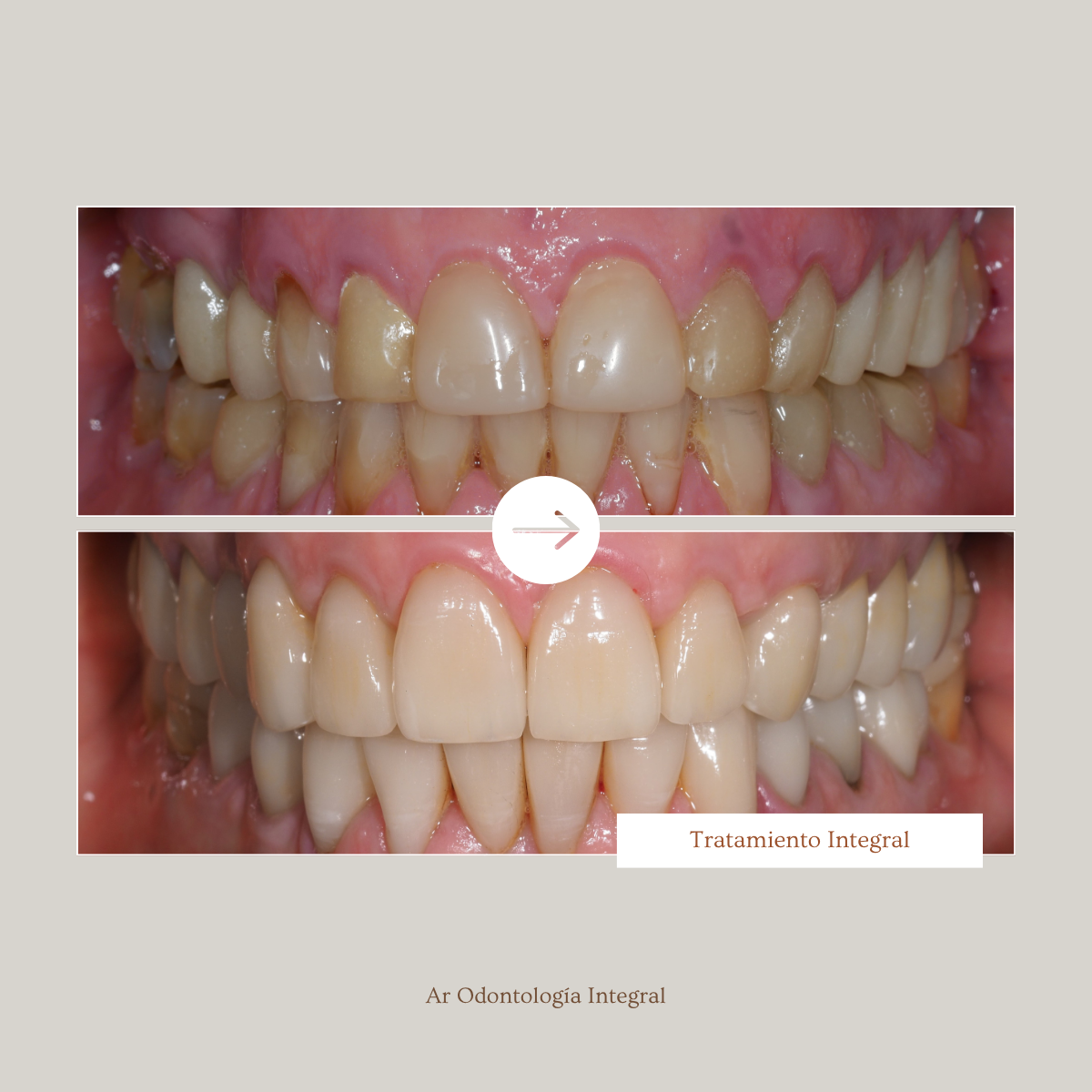 Antes y después — Tratamiento Integral