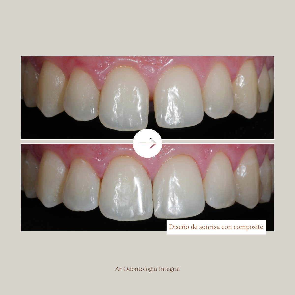 Antes y después — Diseño de sonrisa con composite